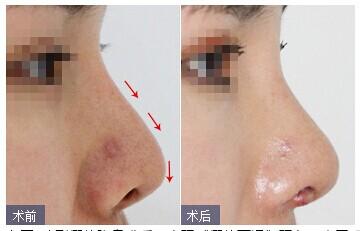海口假體隆鼻.jpg