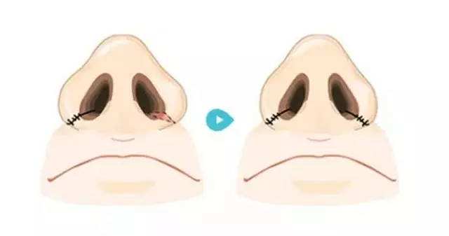 鼻子肥大.jpg