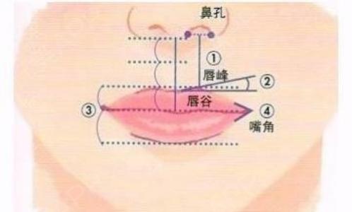 厚唇改薄術(shù).jpg