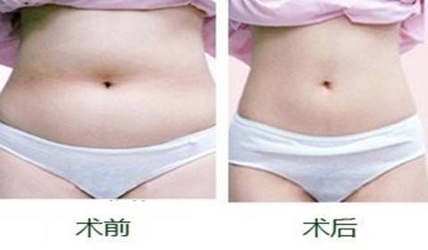 吸脂術.jpg