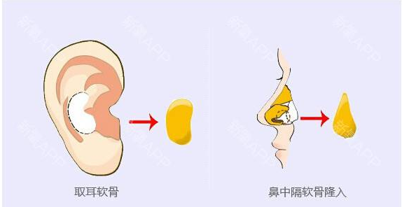 隆鼻.jpg