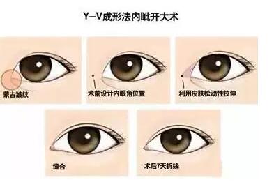 開眼角方法