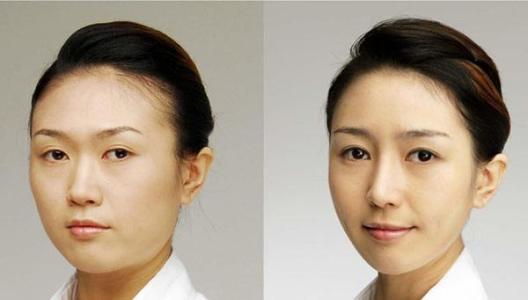 開眼角手術.jpg
