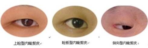 內(nèi)眥贅皮.jpg