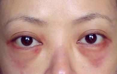 紅眼袋.jpg