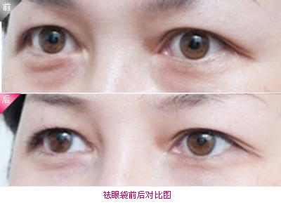 去眼袋.jpg