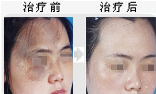 太田痣.jpg