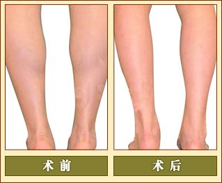 抽脂.jpg