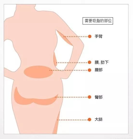吸脂減肥后.jpg