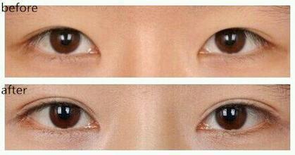 雙眼皮修復(fù).jpg