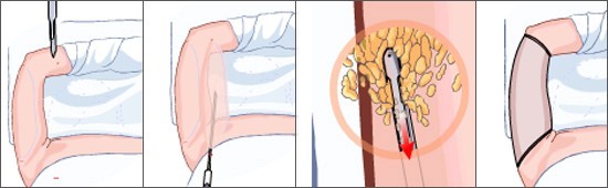 手臂吸脂
